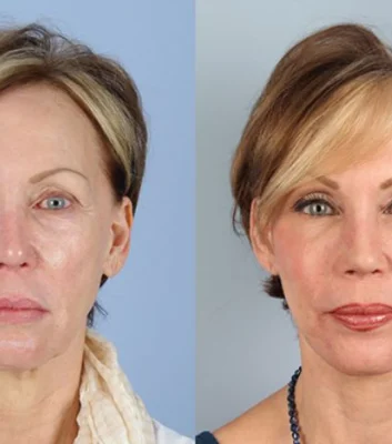 botox-filler-100-1 of 1